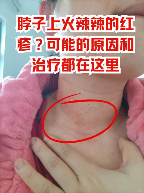 脖子皮肤痒是哪些疾病的信号？