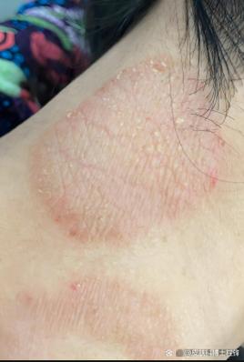 脖子皮肤痒是哪些疾病的信号?