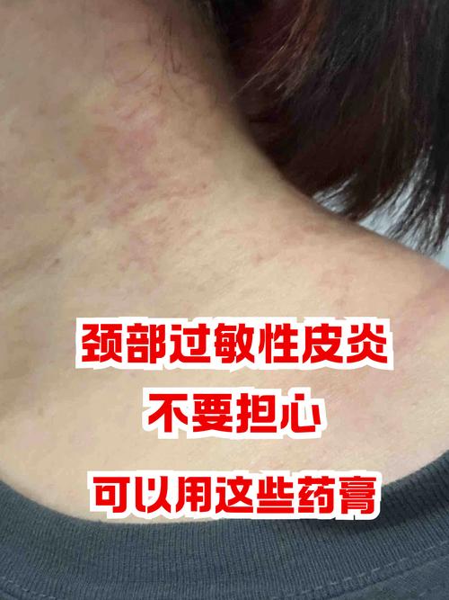 脖子皮肤痒是哪些疾病的信号?