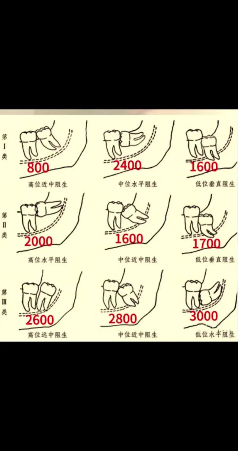 杭州口腔医院拔牙费用大概多少?