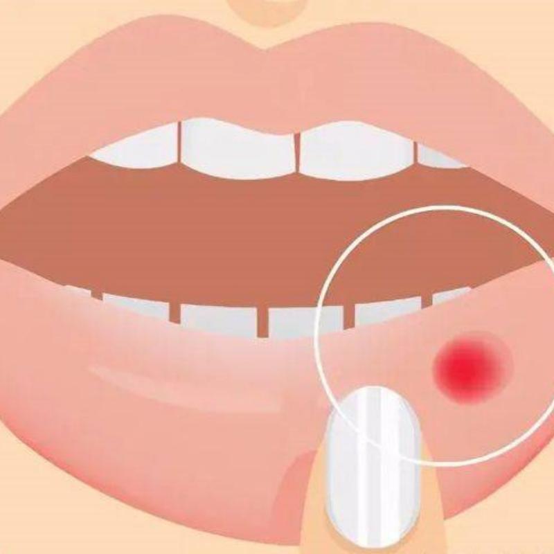 口腔溃疡图片大全能对照自测吗?