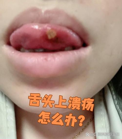 口腔溃疡图片大全能对照自测吗？