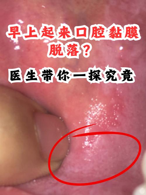 口腔黏膜破损怎么判断？