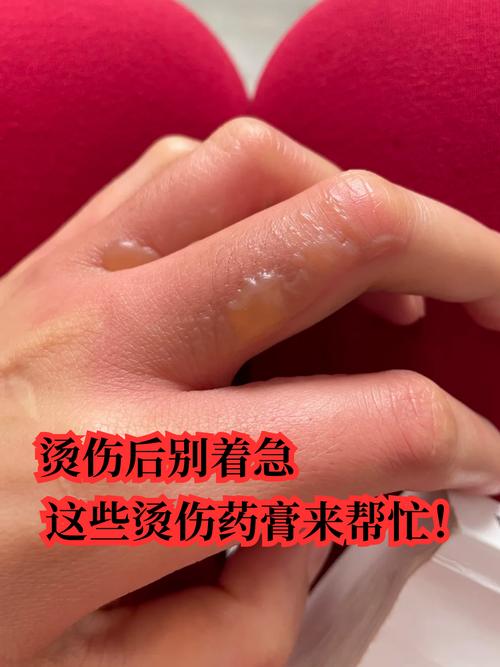 热油烫伤后皮肤怎么紧急处理?