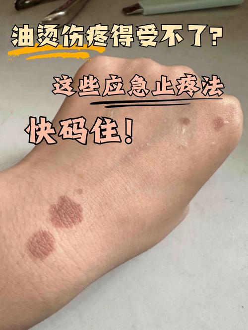 热油烫伤后皮肤怎么紧急处理？