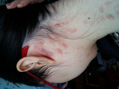 红斑狼疮夜间皮肤瘙痒怎么办?