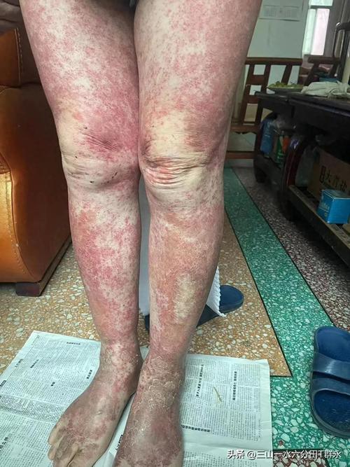 红斑狼疮夜间皮肤瘙痒怎么办？