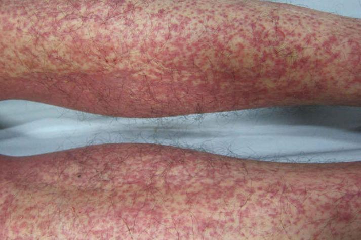 血液病皮肤症状有哪些?