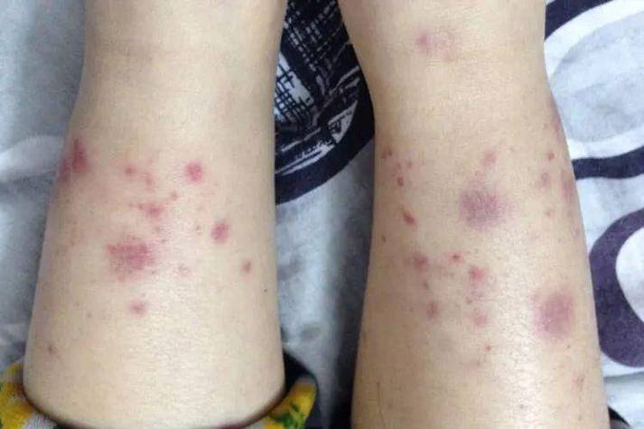 血液病皮肤症状有哪些?