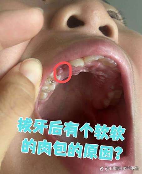 拔牙后口腔感染有哪些症状?