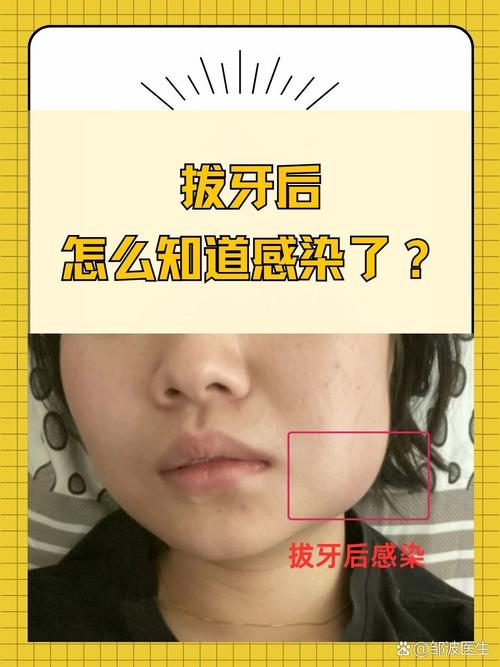 拔牙后口腔感染有哪些症状？