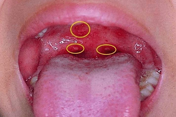 口腔上颚起红点是什么原因?