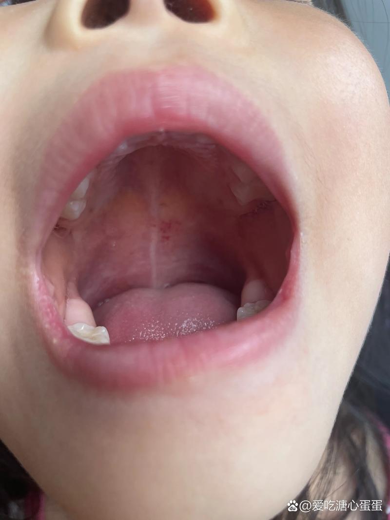 口腔上颚起红点是什么原因?