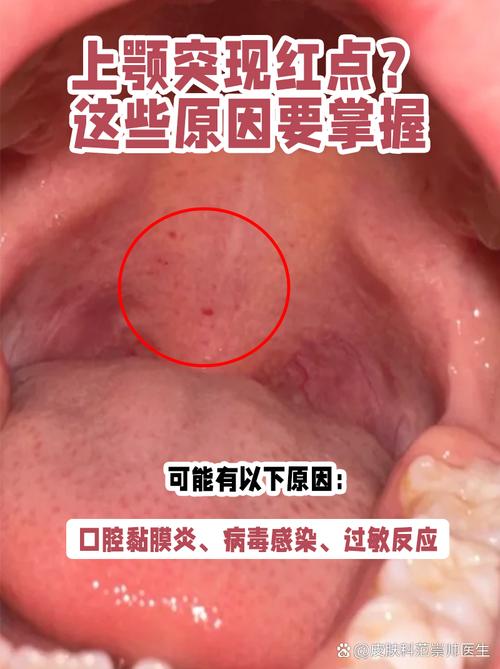 口腔上颚起红点是什么原因？