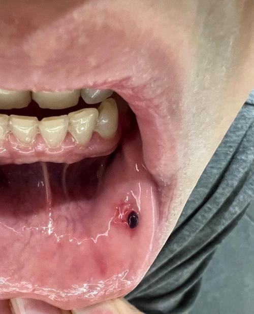 口腔内为何突现血泡？原因何在？