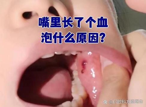口腔内为何突现血泡?原因何在?