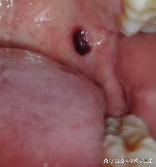 口腔内为何突现血泡?原因何在?