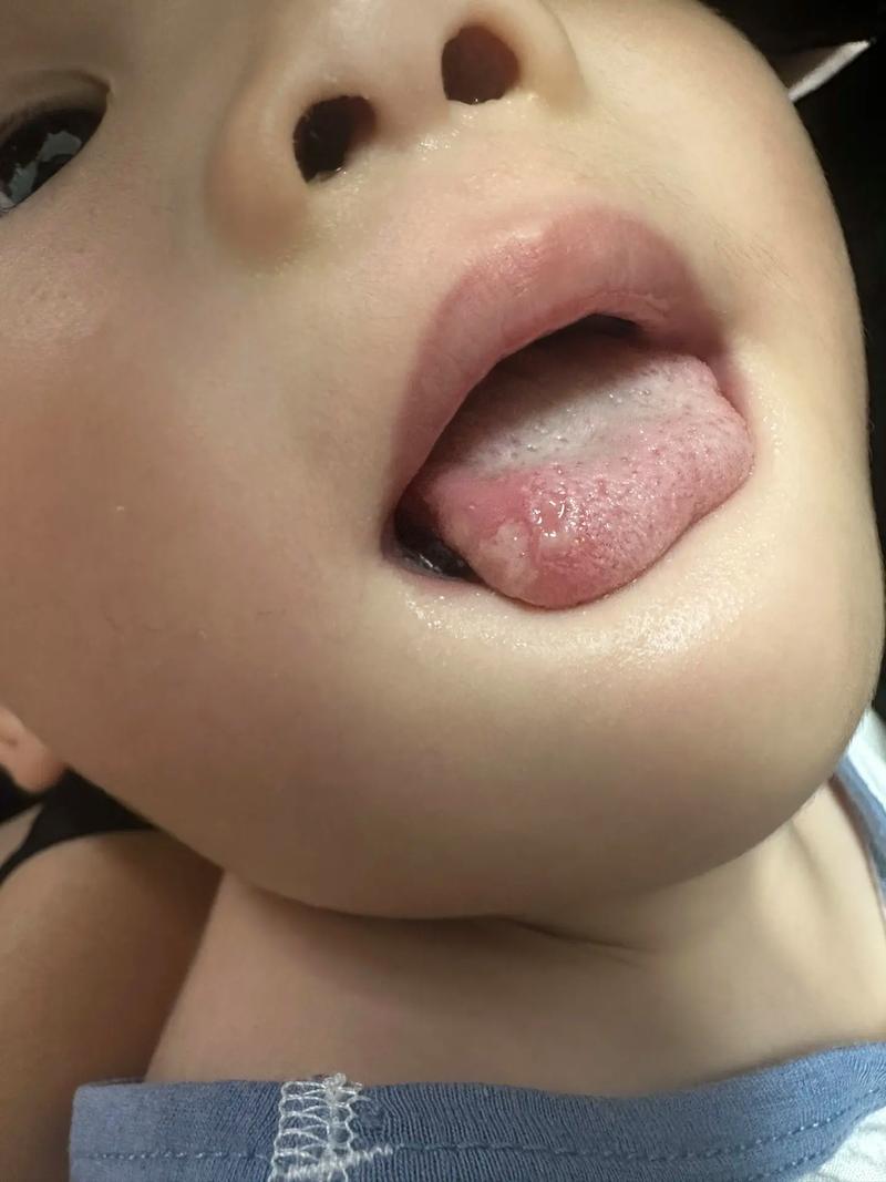 小孩发烧后口腔起水泡是何原因?