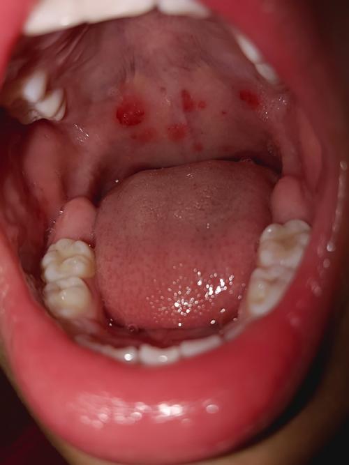 小孩发烧后口腔起水泡是何原因?