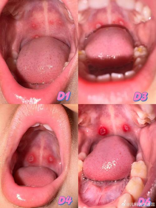 小孩发烧后口腔起水泡是何原因？