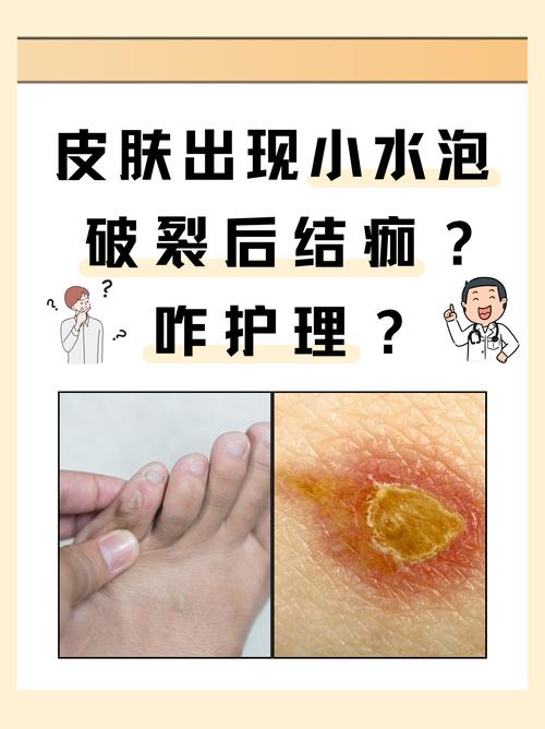 皮肤渗水是啥问题？需要警惕吗？