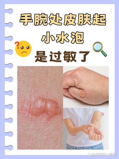 皮肤渗水是啥问题?需要警惕吗?