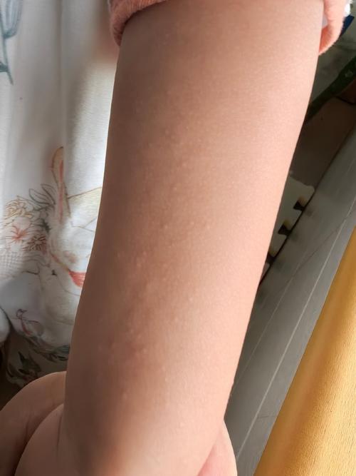 皮肤干燥起小疙瘩是过敏吗？