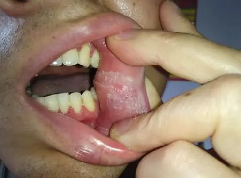 口腔缝针后白膜是正常现象吗?