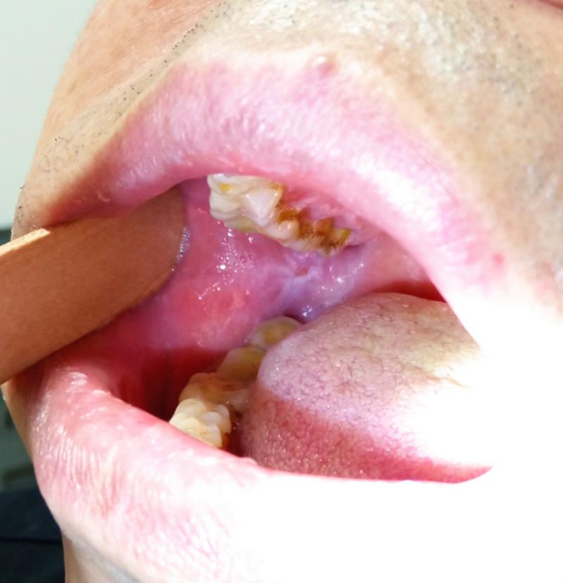 口腔缝针后白膜是正常现象吗?