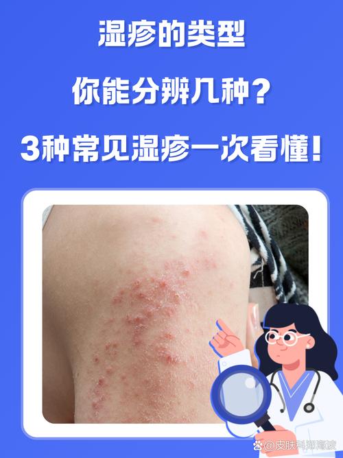 湿疹缠身?究竟啥原因在作祟?