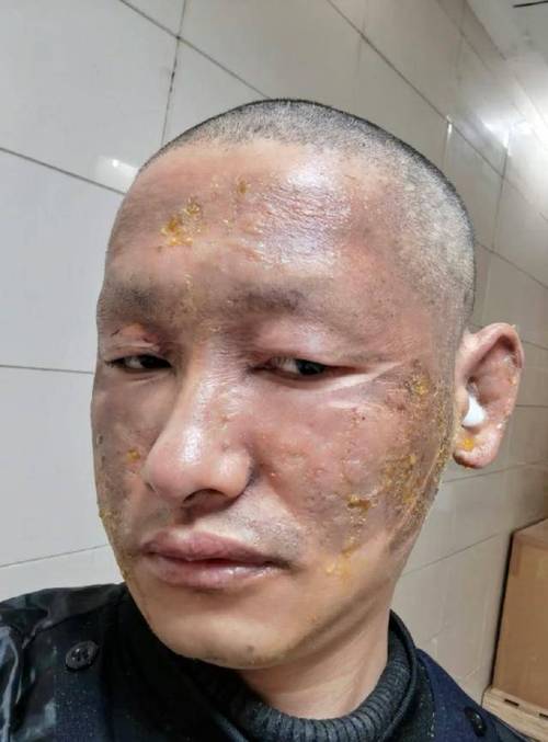 维E擦脸真会毁容?真相究竟如何?