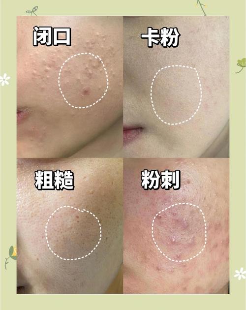 皮肤去角质,定期做才对吗?