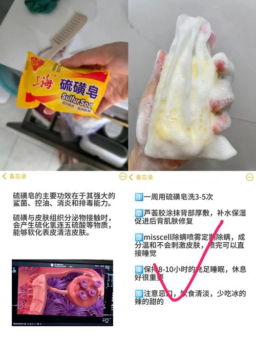 硫磺皂真能去鸡皮肤吗?