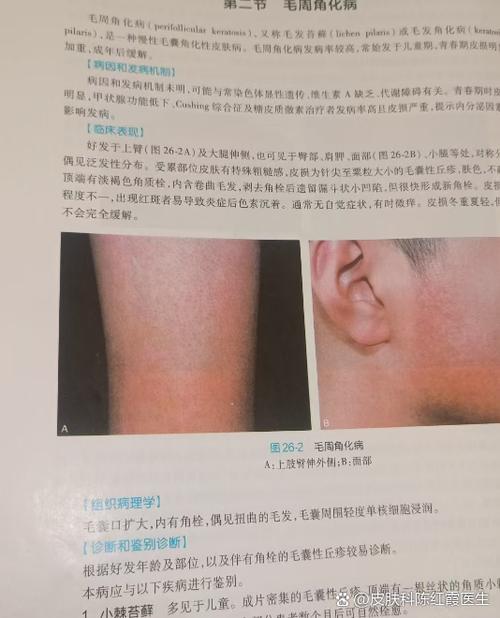 硫磺皂真能去鸡皮肤吗?