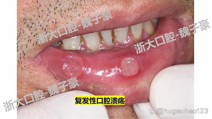 复发性口腔阿弗他溃疡为何反复发作?
