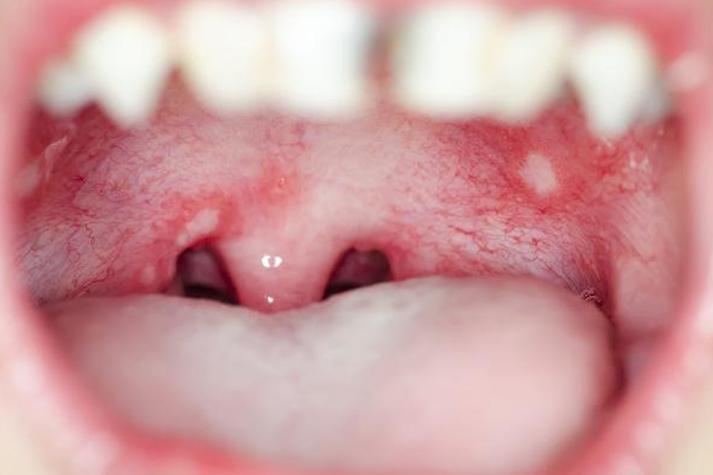 复发性口腔阿弗他溃疡为何反复发作？