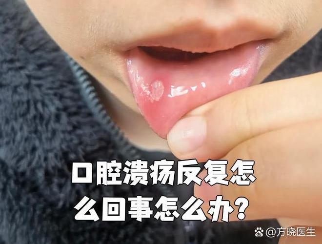 复发性口腔阿弗他溃疡为何反复发作?