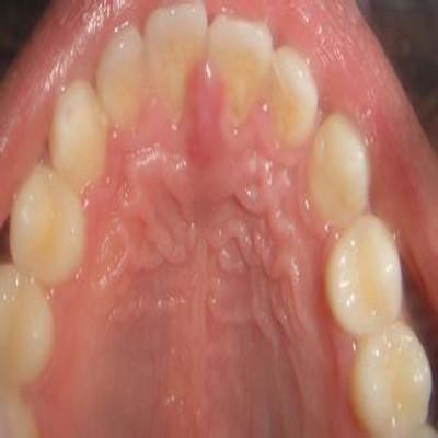 成人口腔疱疹长啥样?图片识别要点有哪些?