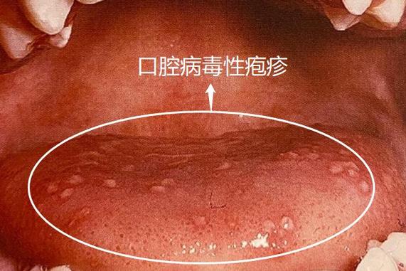 成人口腔疱疹长啥样？图片识别要点有哪些？