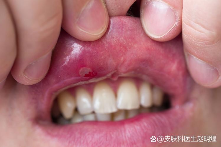 成人口腔疱疹长啥样?图片识别要点有哪些?