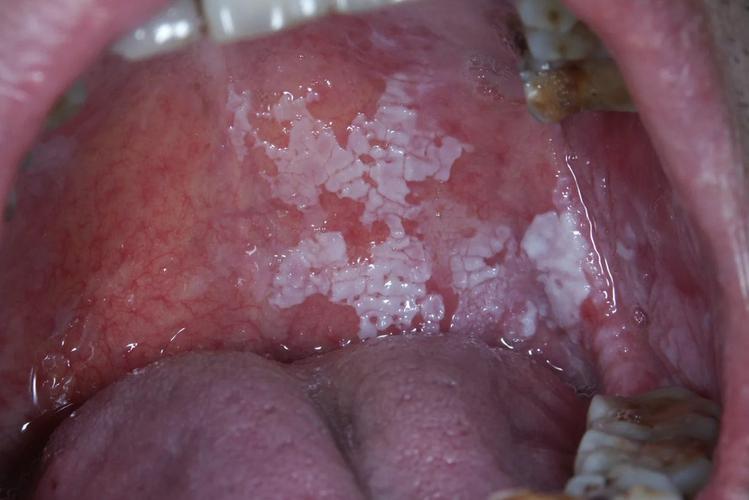 口腔内壁白色物是何原因?需警惕吗?