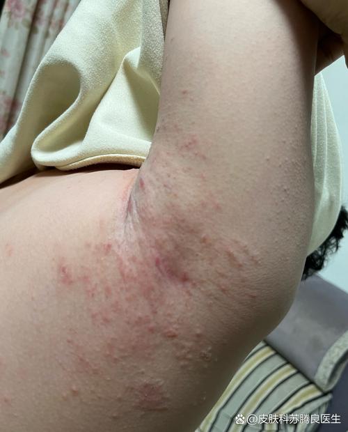 皮肤起红疙瘩很痒，图片显示的是什么问题？