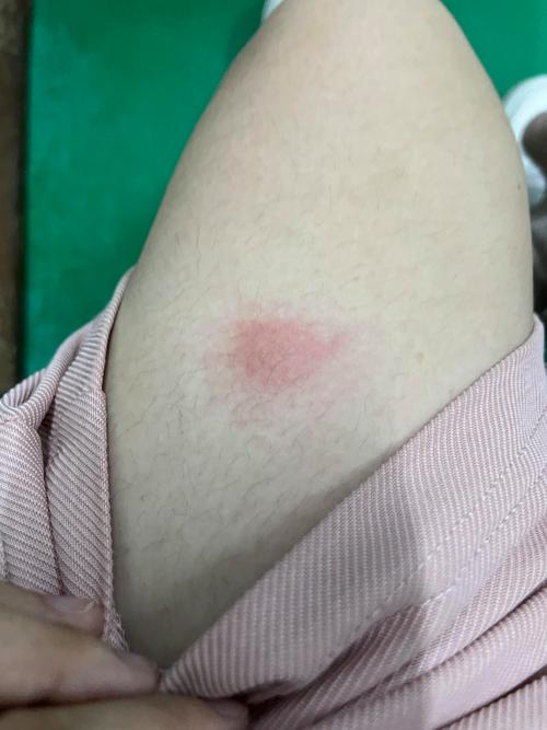 皮肤起红疙瘩很痒,图片显示的是什么问题?