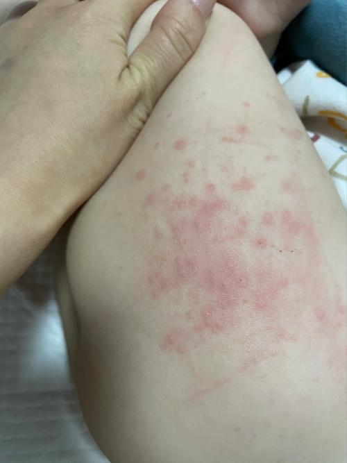 皮肤起红疙瘩很痒,图片显示的是什么问题?