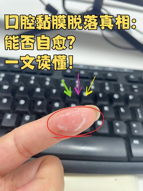 口腔黏膜脱落是缺营养还是生病了？