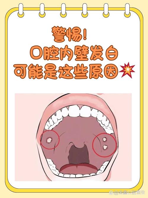 口腔黏膜脱落是缺营养还是生病了?