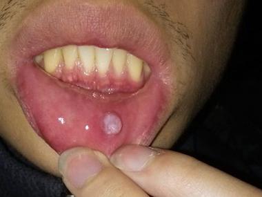 嘴唇口腔溃疡图片大全,如何识别与应对?