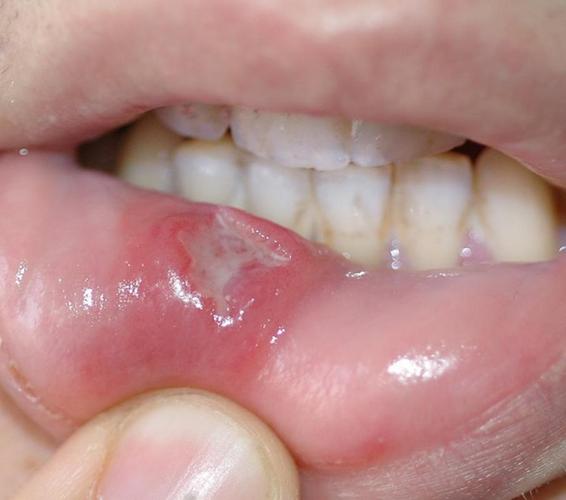 嘴唇口腔溃疡图片大全，如何识别与应对？