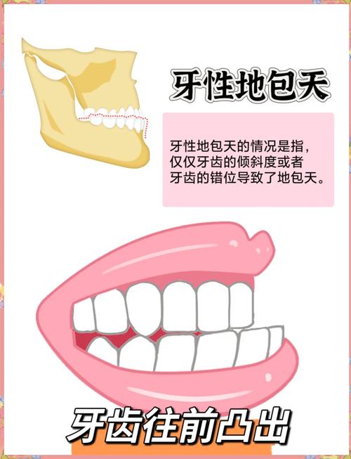 地包天该挂口腔哪个科?