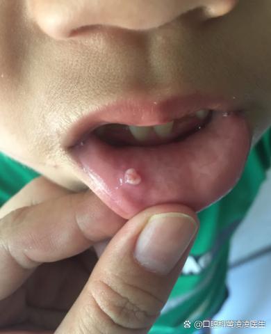 婴儿口腔白色颗粒是何物?